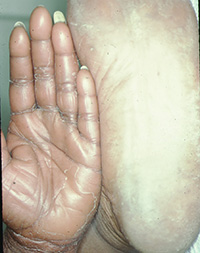 Pityriasis Rubra Pilaris